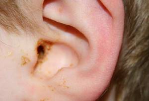 грибы кандида в кишечнике у ребенка симптомы и лечение