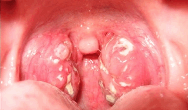 хламидии в горле у ребенка симптомы и лечение