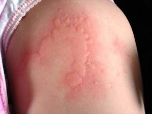 холодовая аллергия у ребенка симптомы и лечение