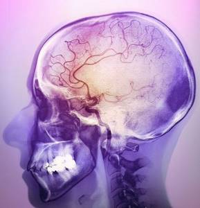 ишемия головного мозга симптомы и лечение у ребенка