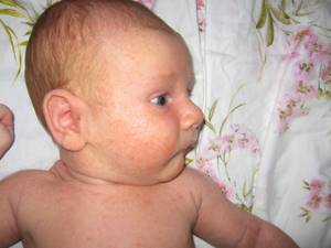 крапивница у грудного ребенка симптомы и лечение