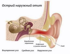 отит уха у ребенка симптомы и лечение