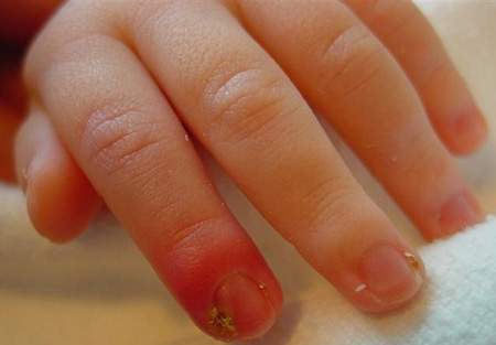 панариций пальца на руке у ребенка симптомы и лечение