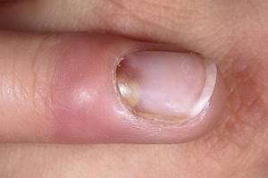 панариций пальца на руке у ребенка симптомы и лечение