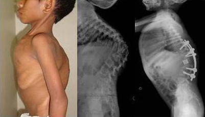 туберкулез костей у ребенка симптомы и лечение