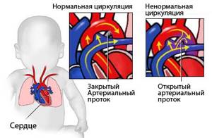 врожденный порок сердца у ребенка симптомы и лечение
