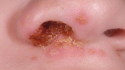 золотистый стафилококк в носу у ребенка симптомы лечение