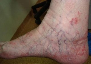 аллергический дерматит симптомы и лечение у взрослых на ногах