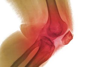 артрит симптомы лечение ноги