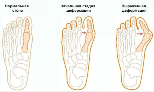 артрит сустава большого пальца ноги симптомы и лечение