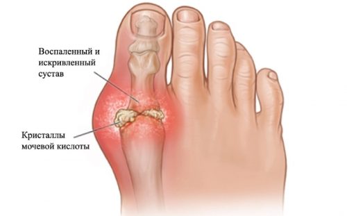 артроз большого пальца ноги симптомы лечение