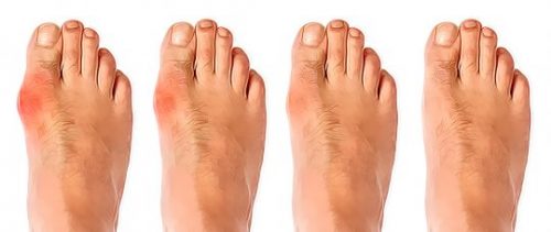 артроз сустава большого пальца ноги симптомы и лечение