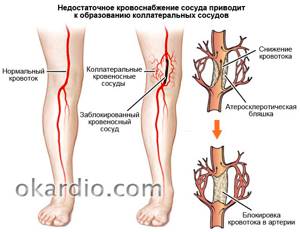 атеросклероз артерий икры ноги симптомы и лечение