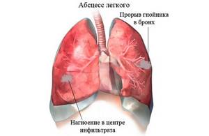 атипичная пневмония у детей симптомы лечение