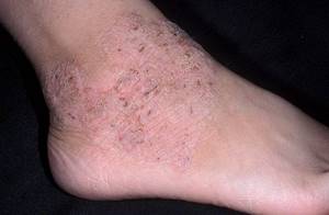 атопический дерматит у детей на ногах симптомы и лечение