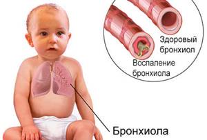 бронхиолит у детей симптомы лечение