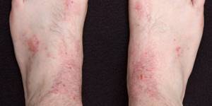 дерматит симптомы и лечение у взрослых на ногах