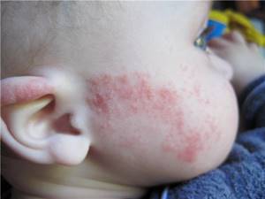 детская аллергия симптомы лечение