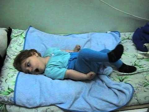 детская эпилепсия симптомы и лечение