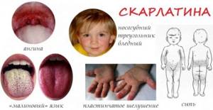 детская скарлатина симптомы и лечение