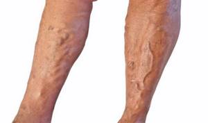 диета при варикозное расширение вен на ногах симптомы и лечение