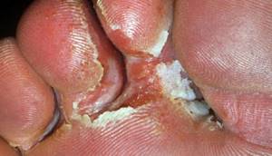 грибковые заболевания кожи симптомы и лечение на ногах