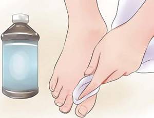 грибок на ногах симптомы и лечение перекисью водорода