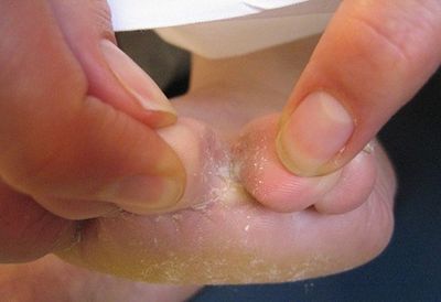грибок на ногах симптомы лечение народными средствами