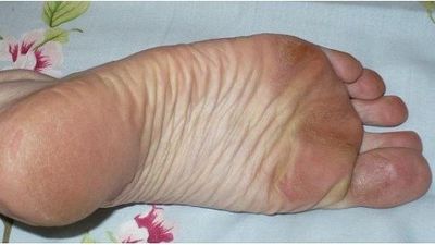 грибок на ногах симптомы лечение народными средствами