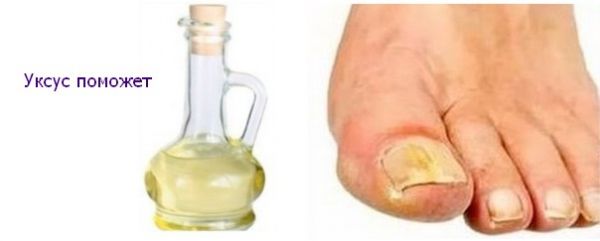 грибок ногтей на ногах симптомы лучшие рецепты лечения
