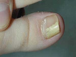 грибок ногтя на большом пальце ноги лечение симптомы