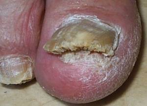 грибок ногтя на большом пальце ноги лечение симптомы