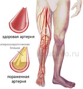 хромота левой ноги причины симптомы лечение