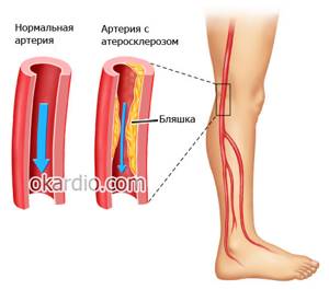 хромота левой ноги причины симптомы лечение