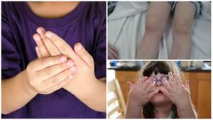 инфекционный артрит симптомы лечение у детей