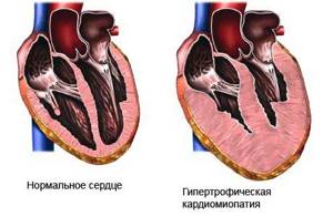 кардиопатия у детей симптомы и лечение