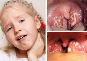 лакунарная ангина симптомы лечение у детей
