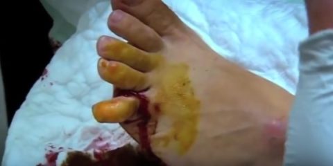 лечение перелом пальца ноги симптомы и лечение в домашних условиях