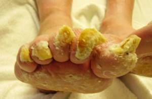 микоз ногтей на ногах симптомы и лечение