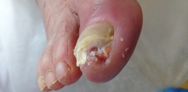 микоз ногтей на ногах симптомы и лечение