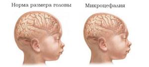 микроцефалия у детей симптомы и лечение