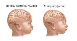 микроцефалия у детей симптомы и лечение