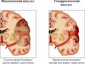 нарушение кровообращения головного мозга у ребенка симптомы и лечение