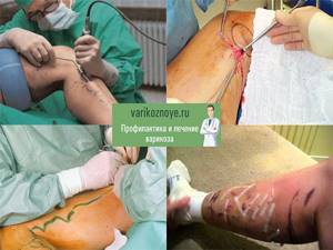 операция варикозное расширение вен на ногах симптомы и лечение