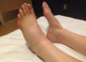 отек стопы ноги симптомы и лечение