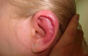 отит среднего уха симптомы и лечение у ребенка 3 лет
