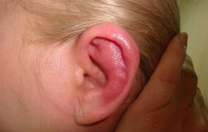 отит среднего уха симптомы и лечение у ребенка 8 лет