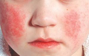 парвовирусная инфекция у детей симптомы лечение
