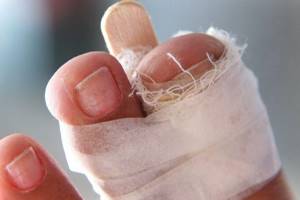 перелом большого пальца ноги симптомы и лечение в домашних