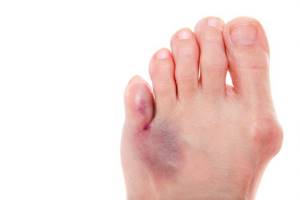 перелом пальца ноги симптомы лечение